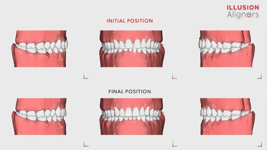Illusion Aligners Takes the World of Orthodontics by Storm with Advanced 3D Technology